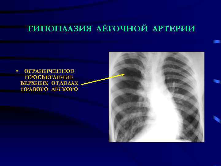 ГИПОПЛАЗИЯ ЛЁГОЧНОЙ АРТЕРИИ • ОГРАНИЧЕННОЕ ПРОСВЕТЛЕНИЕ ВЕРХНИХ ОТДЕЛАХ ПРАВОГО ЛЁГКОГО 