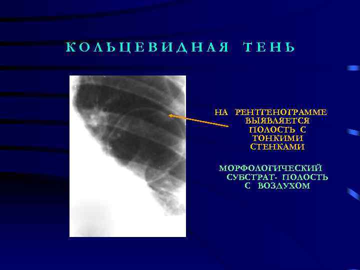КОЛЬЦЕВИДНАЯ ТЕНЬ НА РЕНТГЕНОГРАММЕ ВЫЯВЛЯЕТСЯ ПОЛОСТЬ С ТОНКИМИ СТЕНКАМИ МОРФОЛОГИЧЕСКИЙ СУБСТРАТ- ПОЛОСТЬ C ВОЗДУХОМ