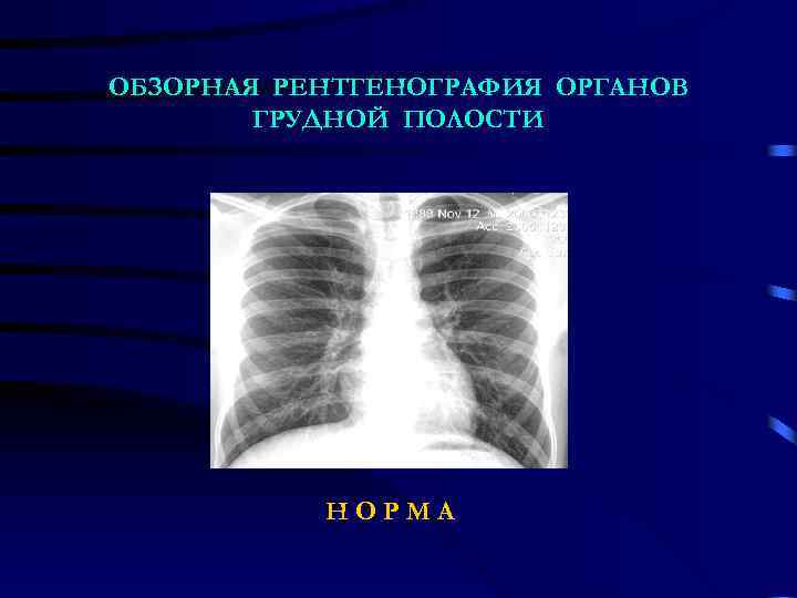 ОБЗОРНАЯ РЕНТГЕНОГРАФИЯ ОРГАНОВ ГРУДНОЙ ПОЛОСТИ НОРМА 