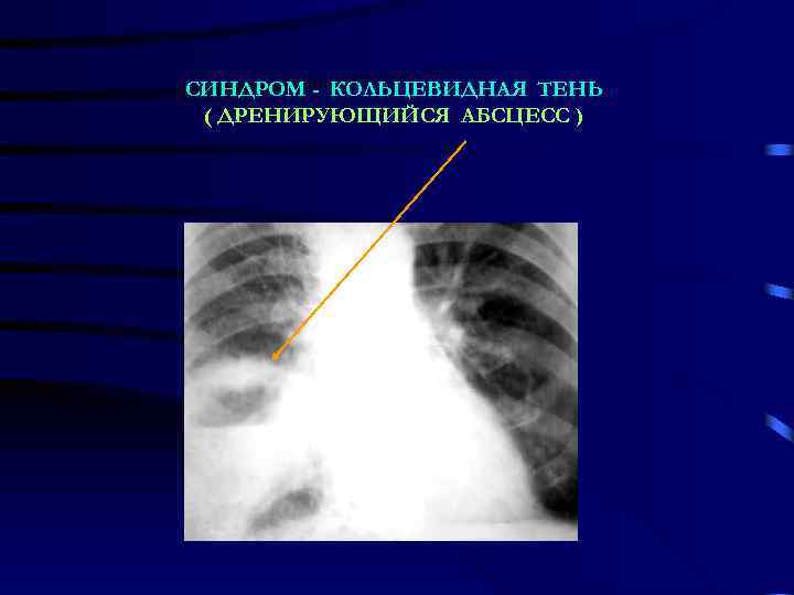 СИНДРОМ - КОЛЬЦЕВИДНАЯ ТЕНЬ ( ДРЕНИРУЮЩИЙСЯ АБСЦЕСС ) 