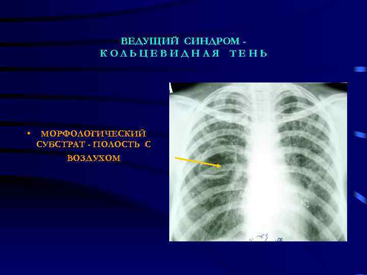 ВЕДУЩИЙ СИНДРОМ КОЛЬЦЕВИДНАЯ ТЕНЬ • МОРФОЛОГИЧЕСКИЙ СУБСТРАТ - ПОЛОСТЬ С ВОЗДУХОМ 