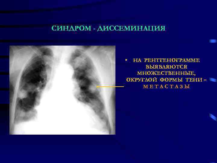 СИНДРОМ - ДИССЕМИНАЦИЯ • НА РЕНТГЕНОГРАММЕ ВЫЯВЛЯЮТСЯ МНОЖЕСТВЕННЫЕ, ОКРУГЛОЙ ФОРМЫ ТЕНИ – МЕТАСТАЗЫ 
