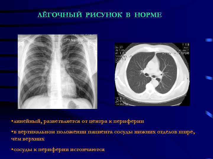 ЛЁГОЧНЫЙ РИСУНОК В НОРМЕ • линейный, разветвляется от центра к периферии • в вертикальном