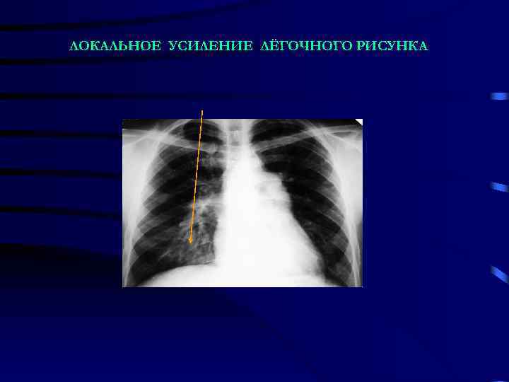 ЛОКАЛЬНОЕ УСИЛЕНИЕ ЛЁГОЧНОГО РИСУНКА 