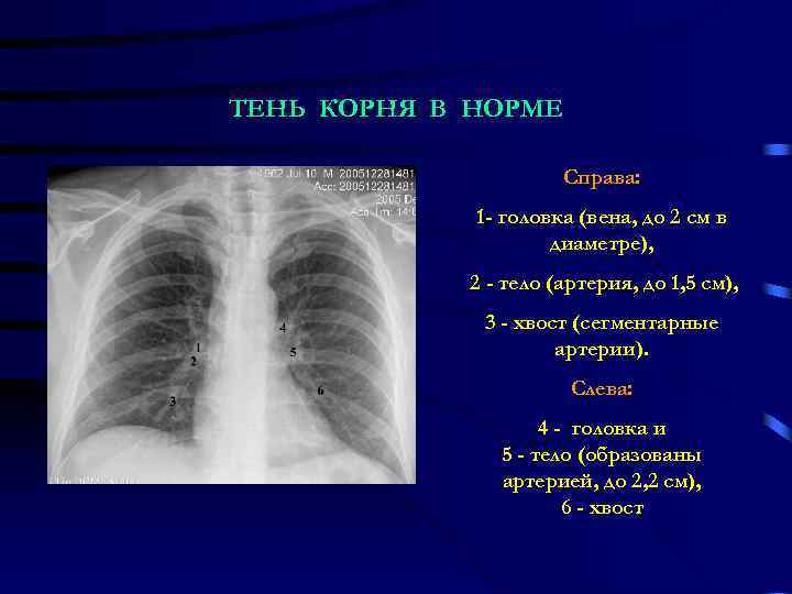 ТЕНЬ КОРНЯ В НОРМЕ Справа: 1 - головка (вена, до 2 см в диаметре),