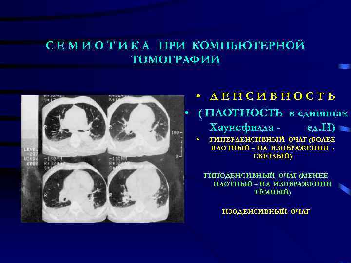 С Е М И О Т И К А ПРИ КОМПЬЮТЕРНОЙ ТОМОГРАФИИ • ДЕНСИВНОСТЬ