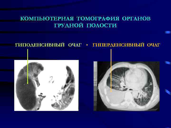 КОМПЬЮТЕРНАЯ ТОМОГРАФИЯ ОРГАНОВ ГРУДНОЙ ПОЛОСТИ ГИПОДЕНСИВНЫЙ ОЧАГ • ГИПЕРДЕНСИВНЫЙ ОЧАГ 