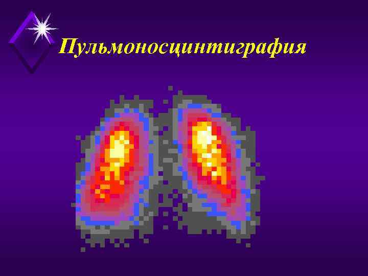 Пульмоносцинтиграфия 