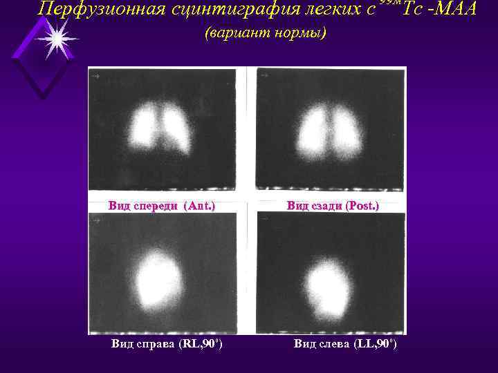 Перфузионная сцинтиграфия легких с 99 м (вариант нормы) Вид спереди (Ant. ) Вид справа