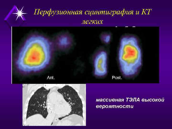 Перфузионная сцинтиграфия и КТ легких Ant. Post. массивная ТЭЛА высокой вероятности 