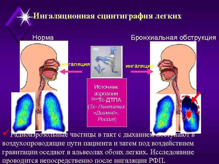 Ингаляционная сцинтиграфия легких Норма Бронхиальная обструкция ингаляция Источник аэрозоля 99 m. Tc-ДТПА (Тс- Пентатех