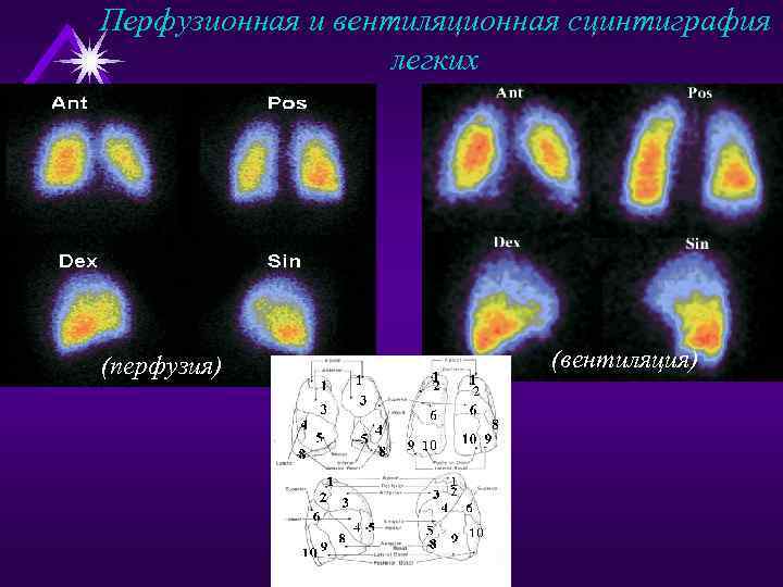 Перфузионная и вентиляционная сцинтиграфия легких (перфузия) (вентиляция) 