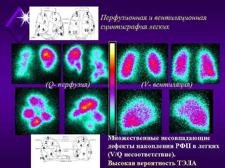 Перфузионная и вентиляционная сцинтиграфия легких (Q- перфузия) (V- вентиляция) Множественные несовпадающие дефекты накопления РФП
