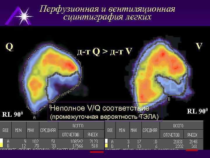 Перфузионная и вентиляционная сцинтиграфия легких Q RL д-т Q > д-т V 900 Неполное