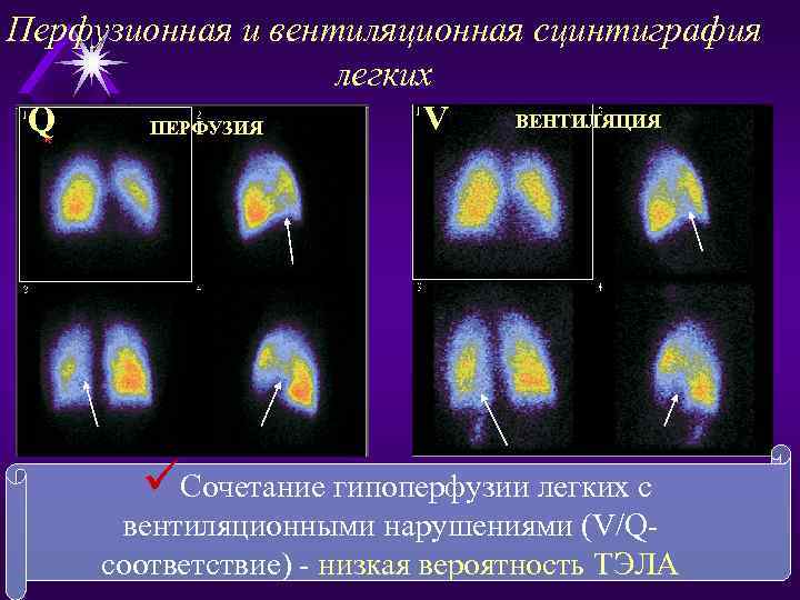 Перфузионная и вентиляционная сцинтиграфия легких ВЕНТИЛЯЦИЯ V Q ПЕРФУЗИЯ üСочетание гипоперфузии легких с вентиляционными