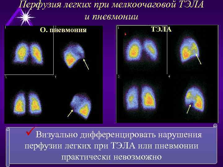 Перфузия легких при мелкоочаговой ТЭЛА и пневмонии ТЭЛА u НГО. пневмония üВизуально дифференцировать нарушения