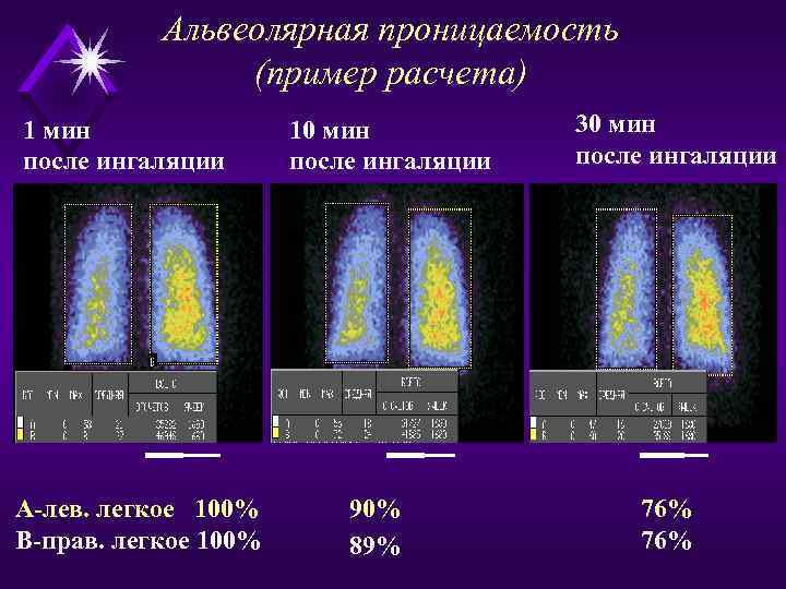 Альвеолярная проницаемость (пример расчета) 1 мин после ингаляции А-лев. легкое 100% В-прав. легкое 100%