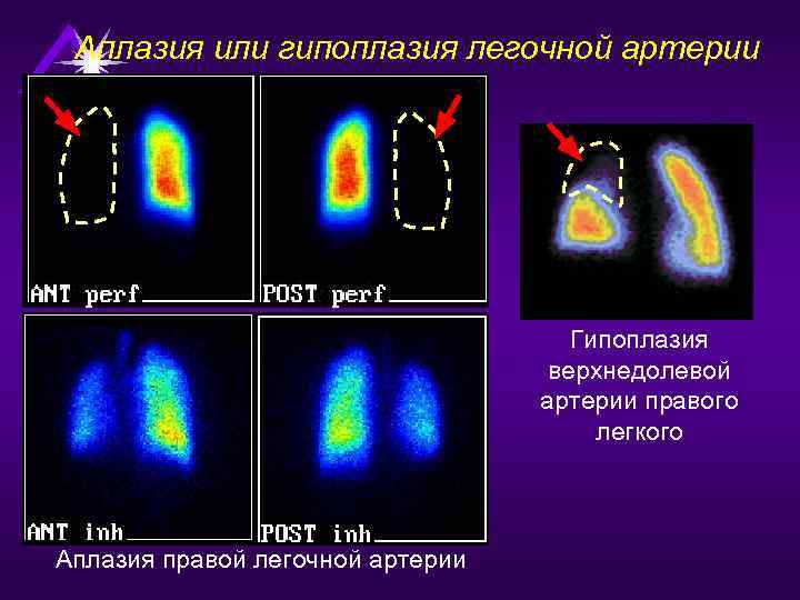 Аплазия или гипоплазия легочной артерии Гипоплазия верхнедолевой артерии правого легкого Аплазия правой легочной артерии