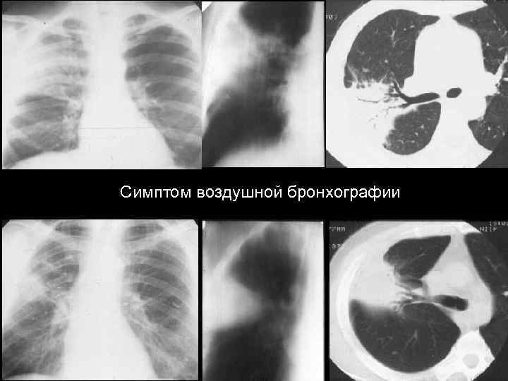 Симптом воздушной бронхографии 
