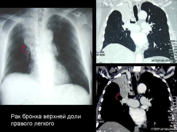 Стадии рака бронха. Опухоль бронха рентген. Бронхогенная карцинома на кт. Бронхогенная карцинома легких.