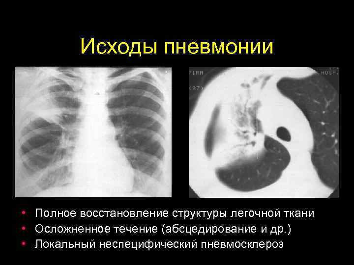 Исходы пневмонии • Полное восстановление структуры легочной ткани • Осложненное течение (абсцедирование и др.