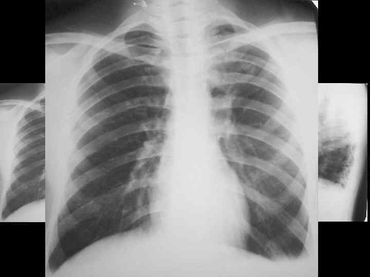 Эндобронхиальный рак 