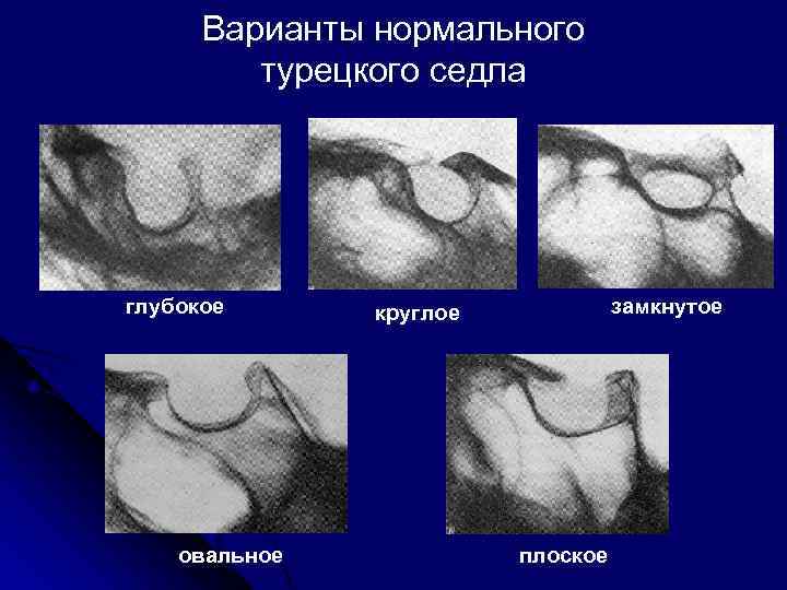 Варианты нормального турецкого седла глубокое овальное замкнутое круглое плоское 