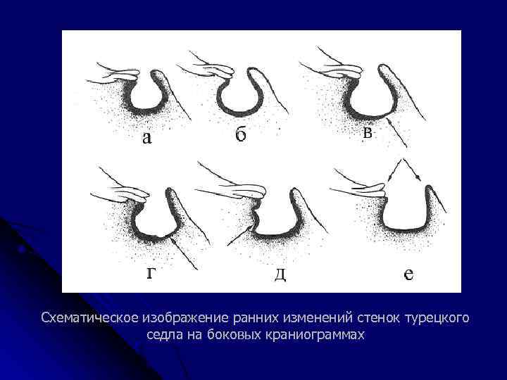 Схематическое изображение ранних изменений стенок турецкого седла на боковых краниограммах 