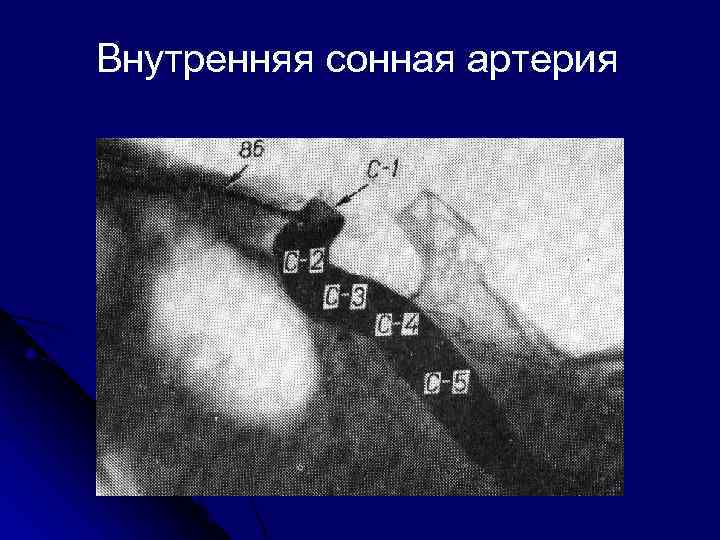 Внутренняя сонная артерия 