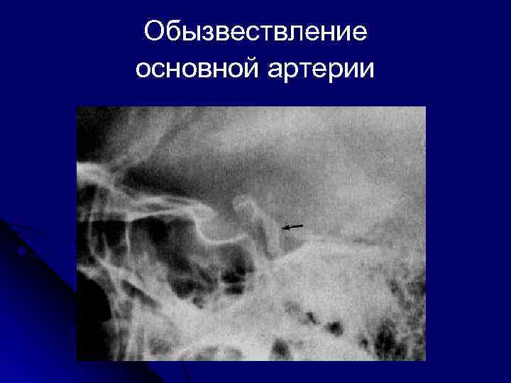 Обызвествление это. Обызвествление сосудов. Обызвествление сосудов рентген. Обызвествление кровеносных сосудов.