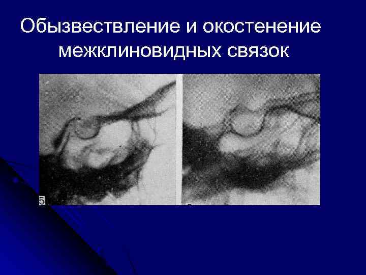 Обызвествление и окостенение межклиновидных связок 