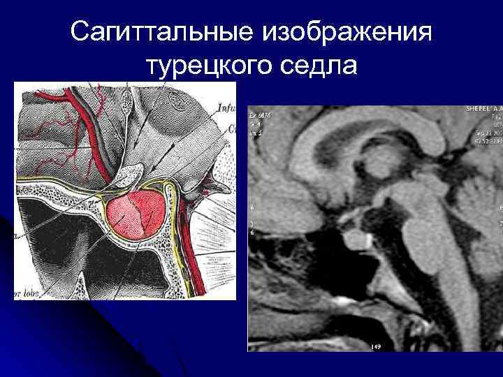 Сагиттальные изображения турецкого седла 