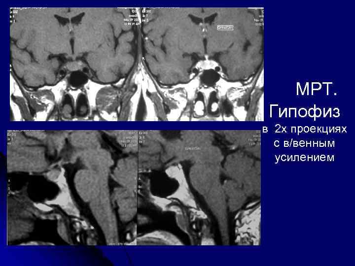  МРТ. Гипофиз в 2 х проекциях с в/венным усилением 
