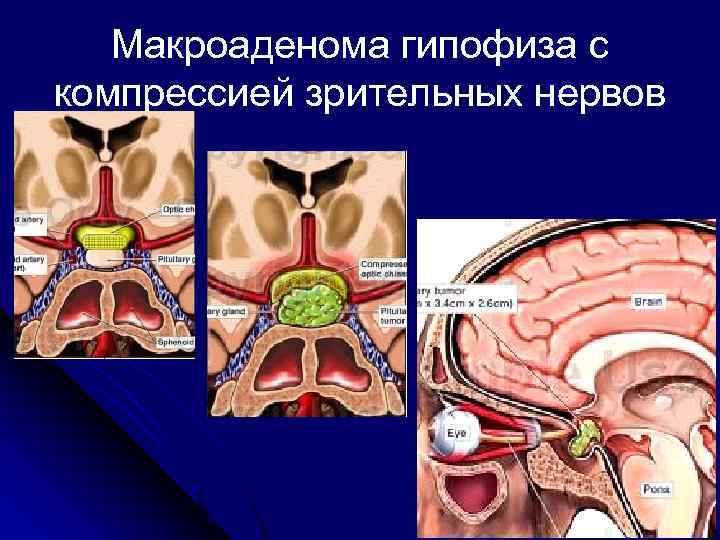 Макроаденома гипофиза