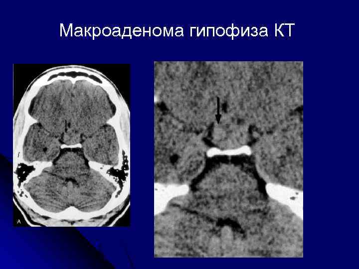 Макроаденома гипофиза