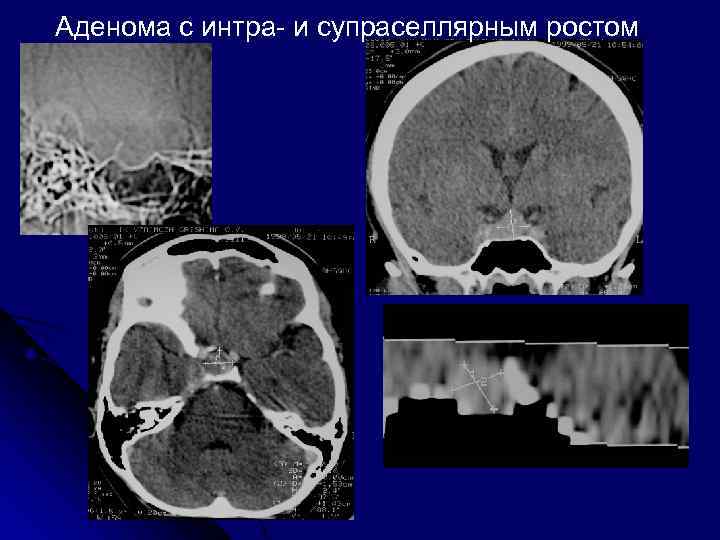 Супраселлярная цистерна пролабирует в полость