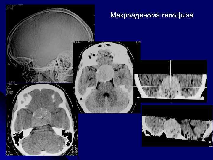 Картина микроаденомы гипофиза