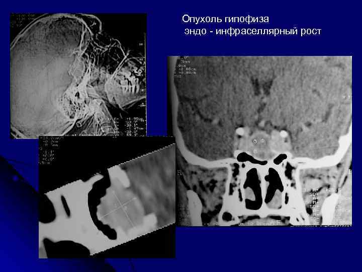 Опухоль гипофиза эндо - инфраселлярный рост 