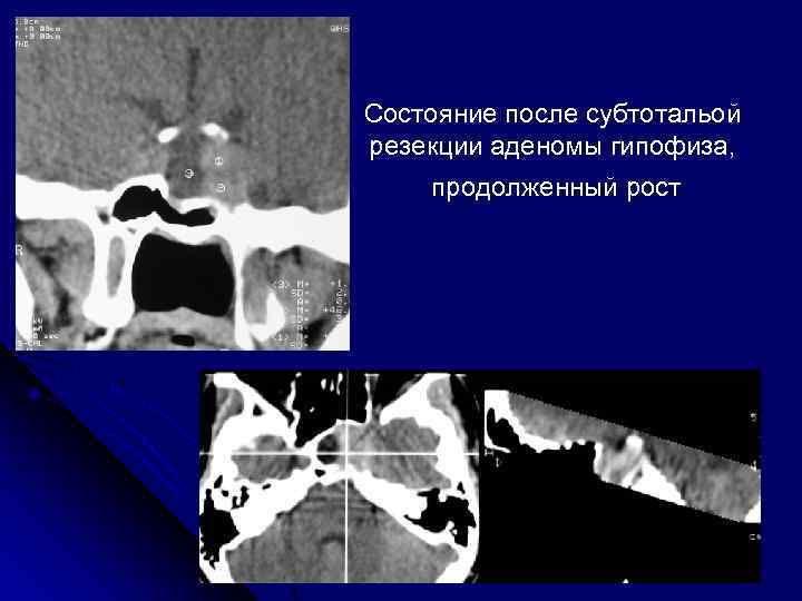 Состояние после субтотальой резекции аденомы гипофиза, продолженный рост 