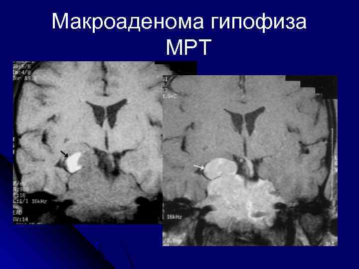 Макроаденома гипофиза