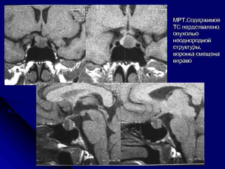 Образование мрт. Утолщение воронки гипофиза мрт. Образование воронки гипофиза мрт. Опухоль неоднородной структуры. Воронка гипофиза смещена вправо.