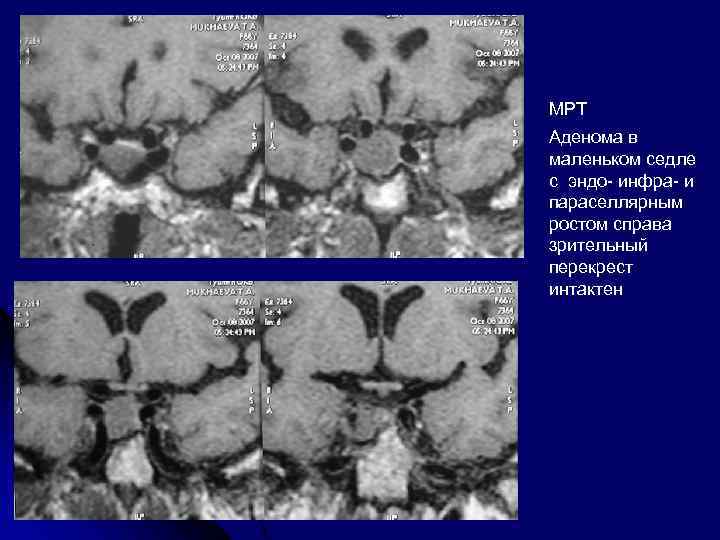 МРТ Аденома в маленьком седле с эндо- инфра- и параселлярным ростом справа зрительный перекрест