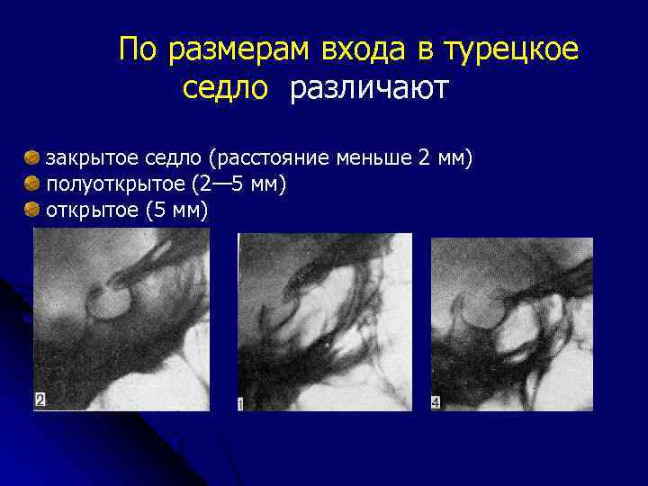 По размерам входа в турецкое седло различают закрытое седло (расстояние меньше 2 мм) полуоткрытое