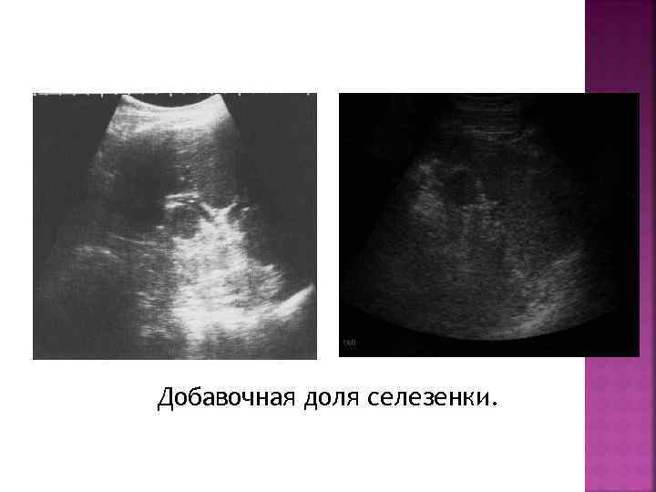 Добавочная доля селезенки. 