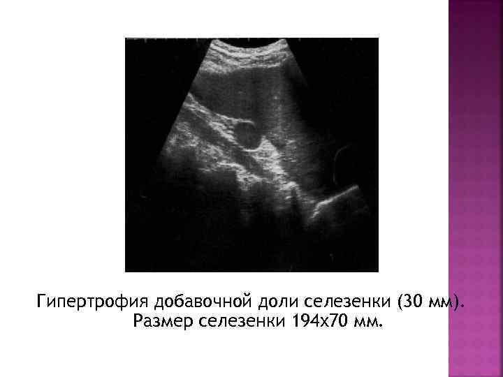 Гипертрофия добавочной доли селезенки (30 мм). Размер селезенки 194 х70 мм. 