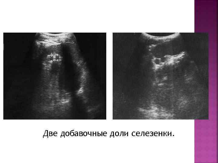 Две добавочные доли селезенки. 