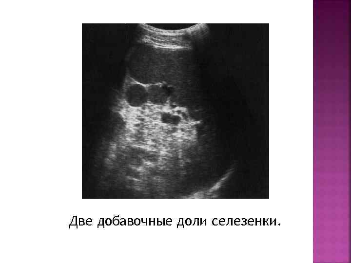 Две добавочные доли селезенки. 