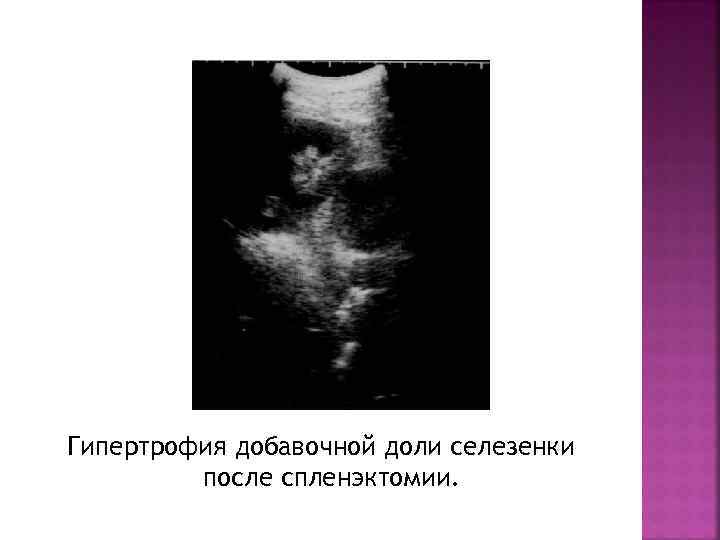 Гипертрофия добавочной доли селезенки после спленэктомии. 