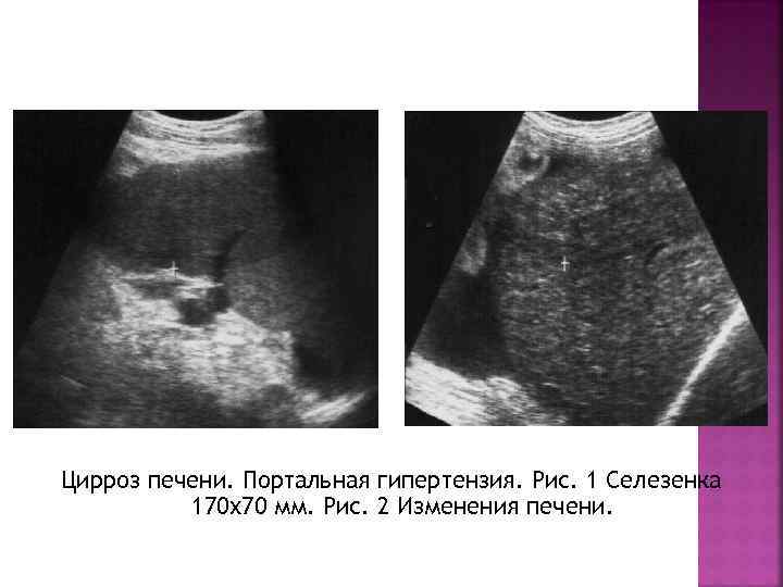 Цирроз печени. Портальная гипертензия. Рис. 1 Селезенка 170 х70 мм. Рис. 2 Изменения печени.