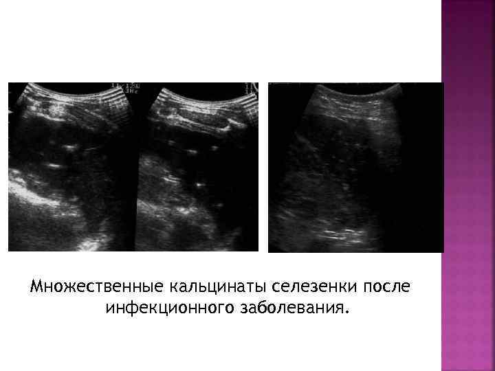 Множественные кальцинаты селезенки после инфекционного заболевания. 